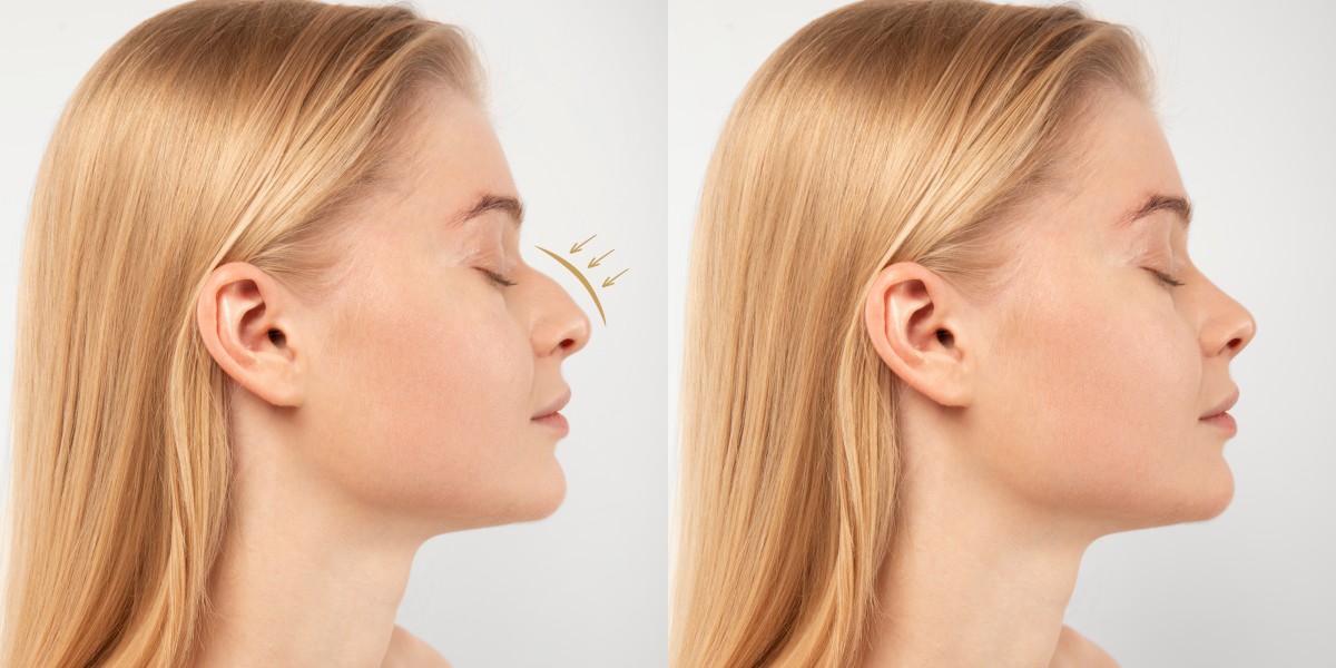 Burun Estetiği Ameliyatı